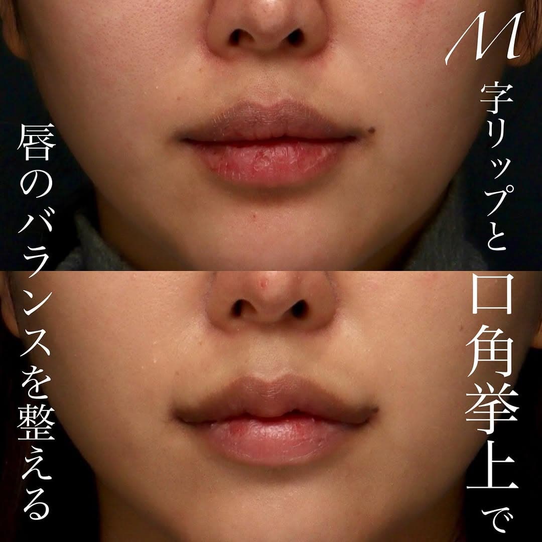 M字リップ+口角挙上の複合手術でかわいくメリハリのある口元に整えた症例