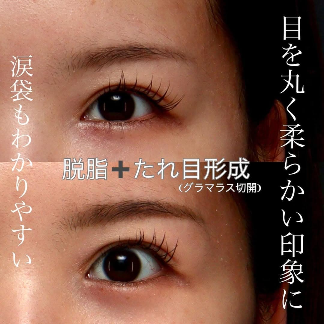 脱脂(くまとり)+グラマラス(たれ目形成)で中顔面が短く見える丸い目元に整えた症例