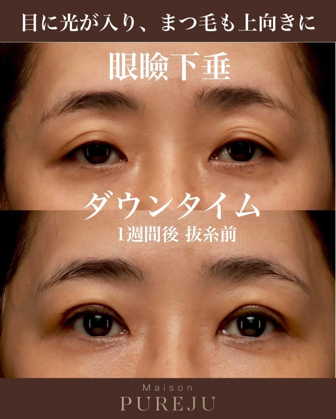 眼瞼下垂手術術後1週間(抜糸前)のダウンタイム経過を記録した症例