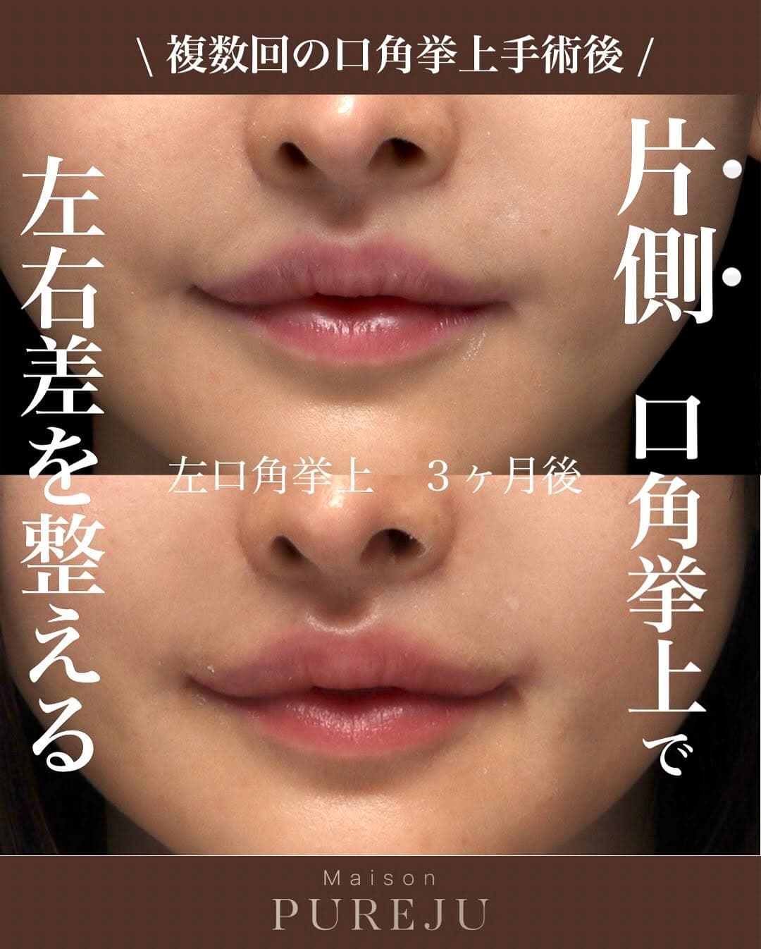 片側口角挙上で口角の左右差を整えた術後3ヶ月の症例