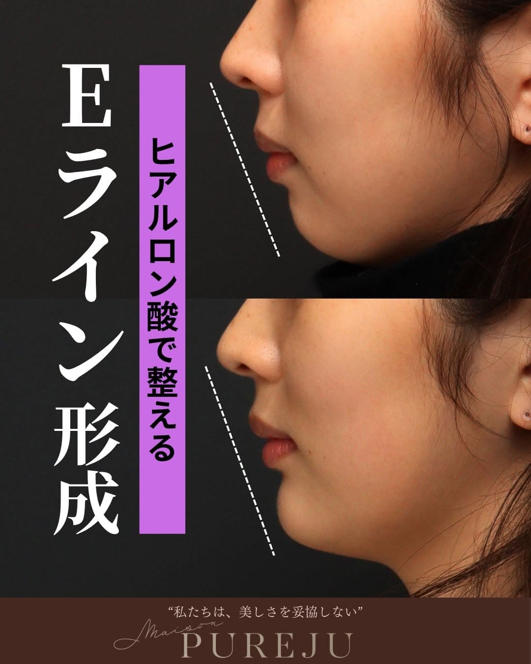 Eライン形成とは|ヒアルロン酸注入で横顔の美しさを整えるMaison PUREJUの症例と施術