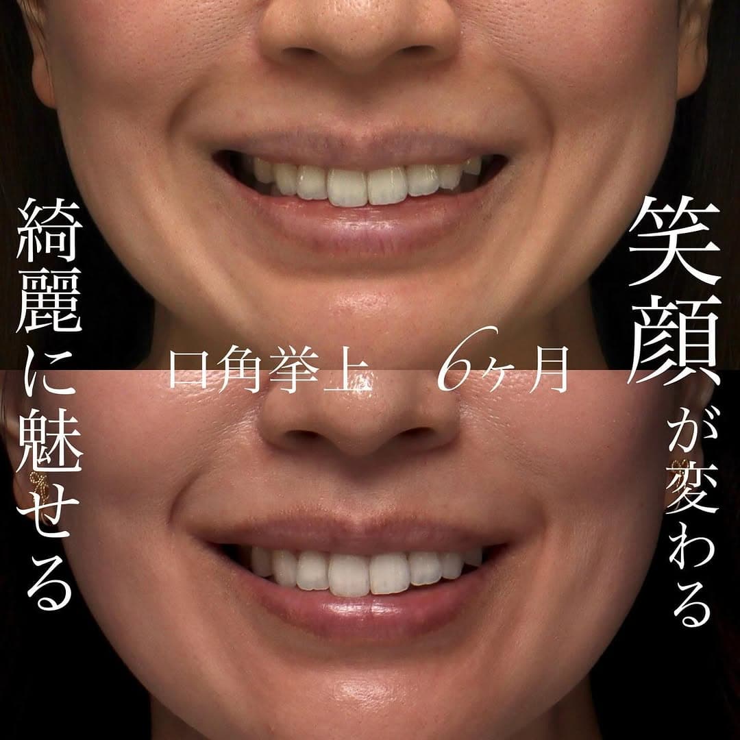 口角挙上で笑いやすさと笑顔の印象を同時に改善した症例