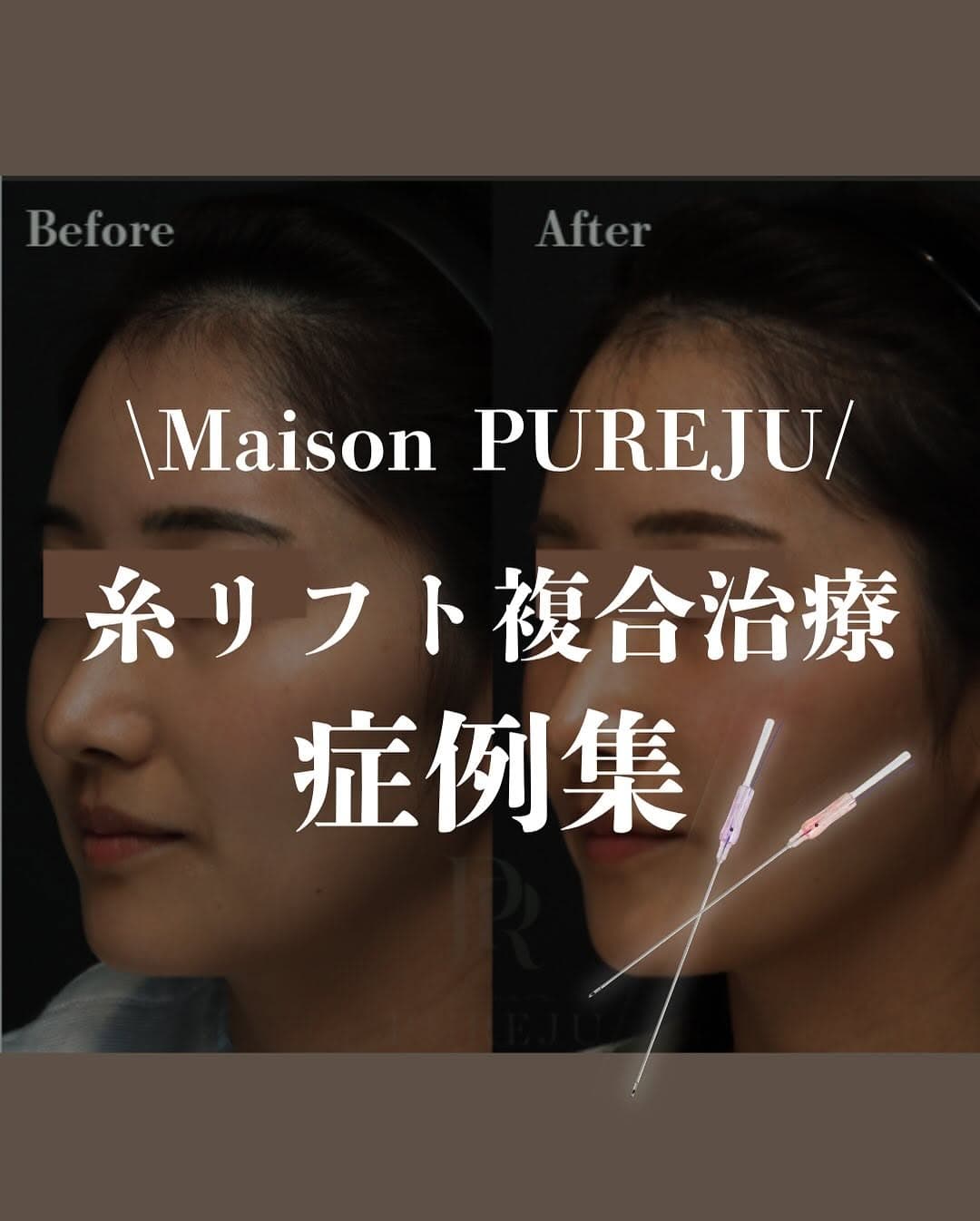 糸リフト×複合治療|ヒアルロン酸・RF・ショートスレッド・脂肪溶解を組み合わせた輪郭美の作り方
