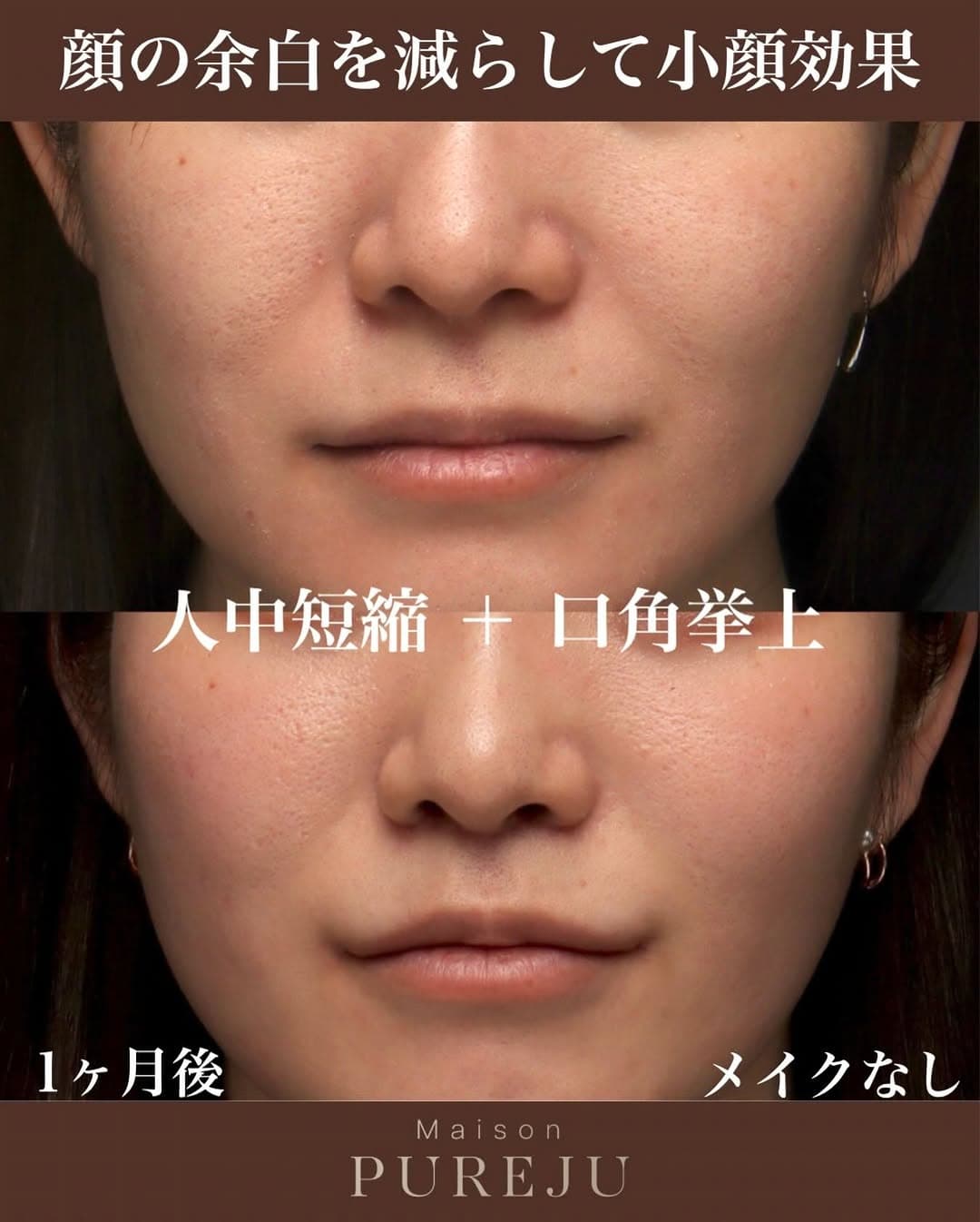 人中短縮+口角挙上で顔の余白を大幅に減らし小顔効果を実現した症例