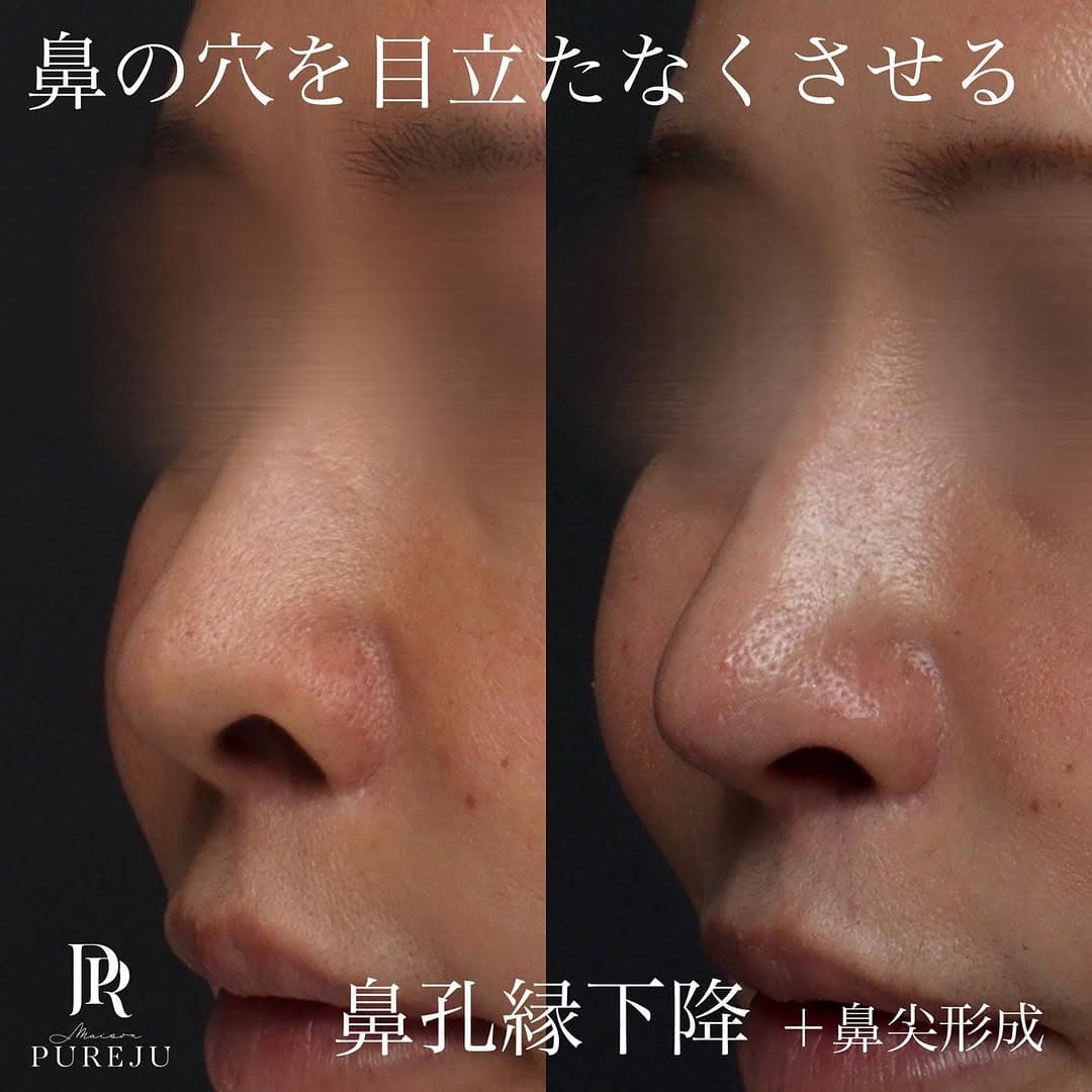 鼻孔縁下降+鼻尖形成+耳介軟骨移植で鼻の穴の目立ちを改善した症例
