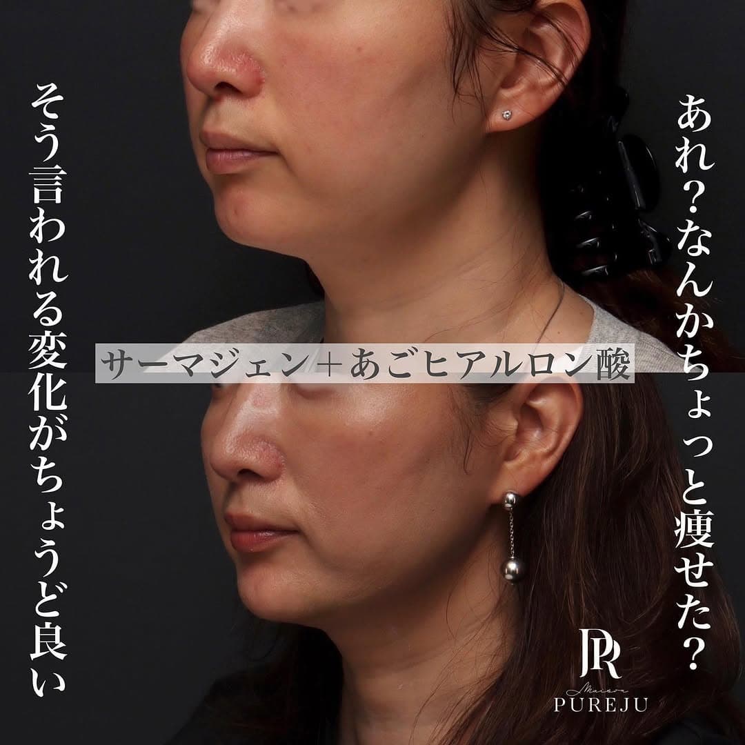 サーマジェン(RF)×あごヒアルロン酸でフェイスラインをすっきり整えた症例