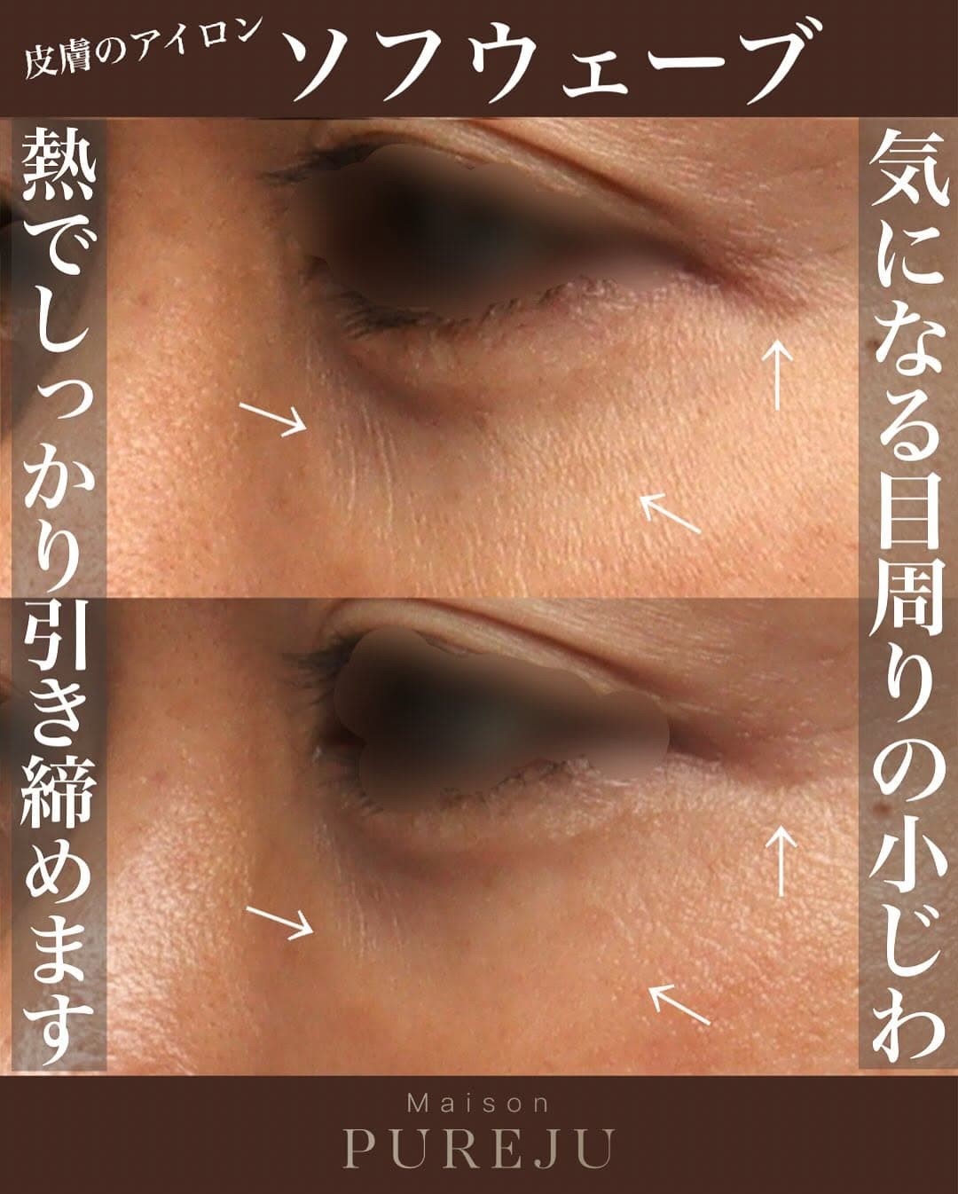 ソフウェーブで目周りの小じわをアイロンのようにピンと伸ばした症例