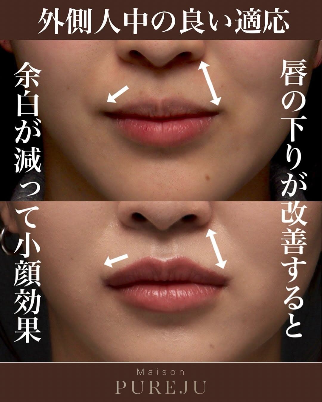 外側人中手術で唇の外側の下りを改善しお顔の余白を減らした症例