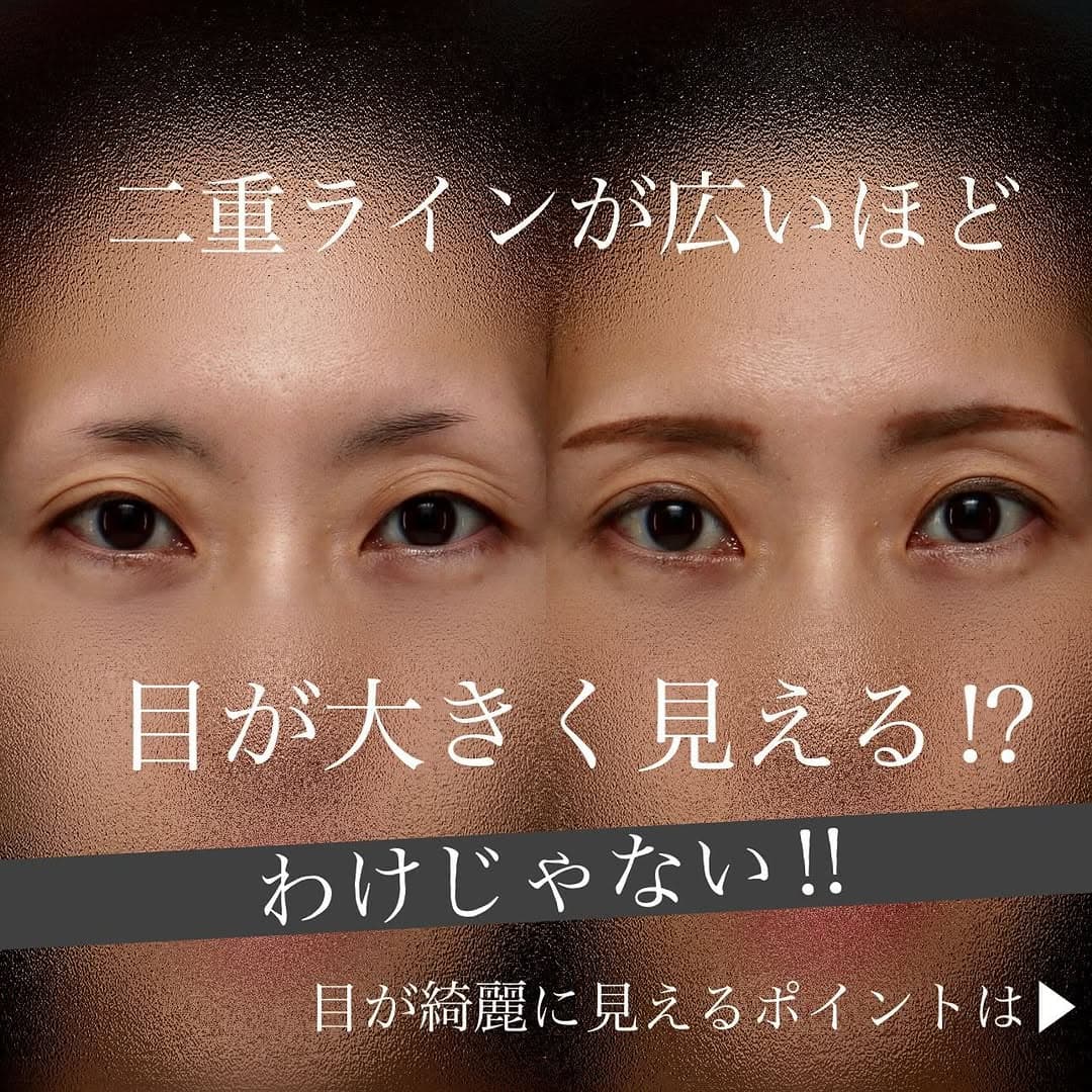 二重幅と自然な二重ラインを意識した二重埋没でまつ毛が上向きにきれいに出た症例