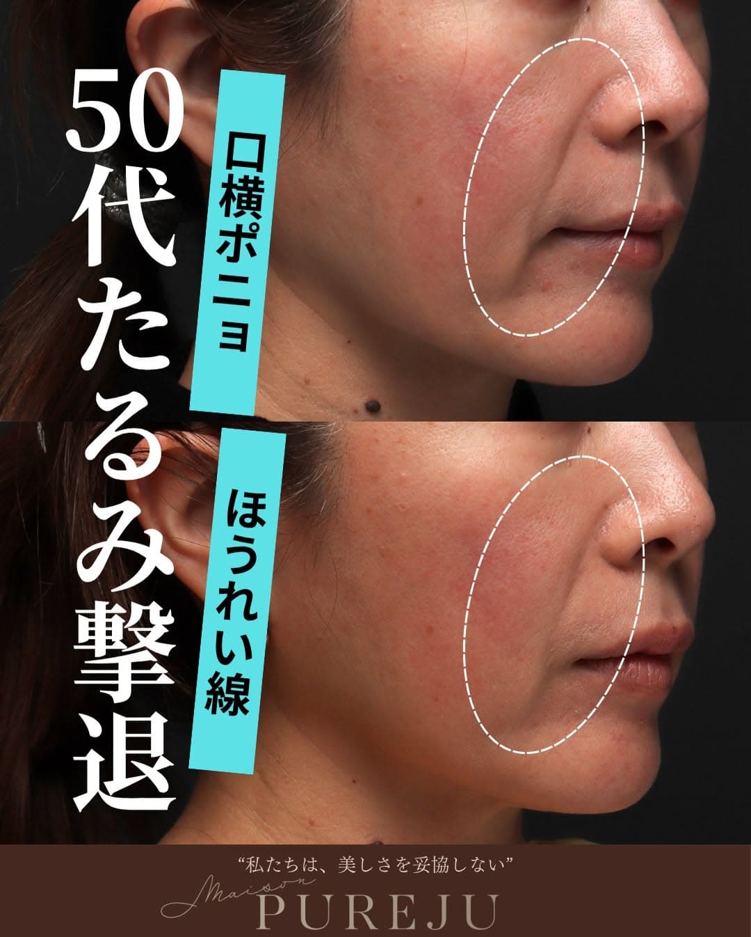 50代のたるみにはWアプローチが効果的|XERF×ウルトラセルZiの組み合わせ治療