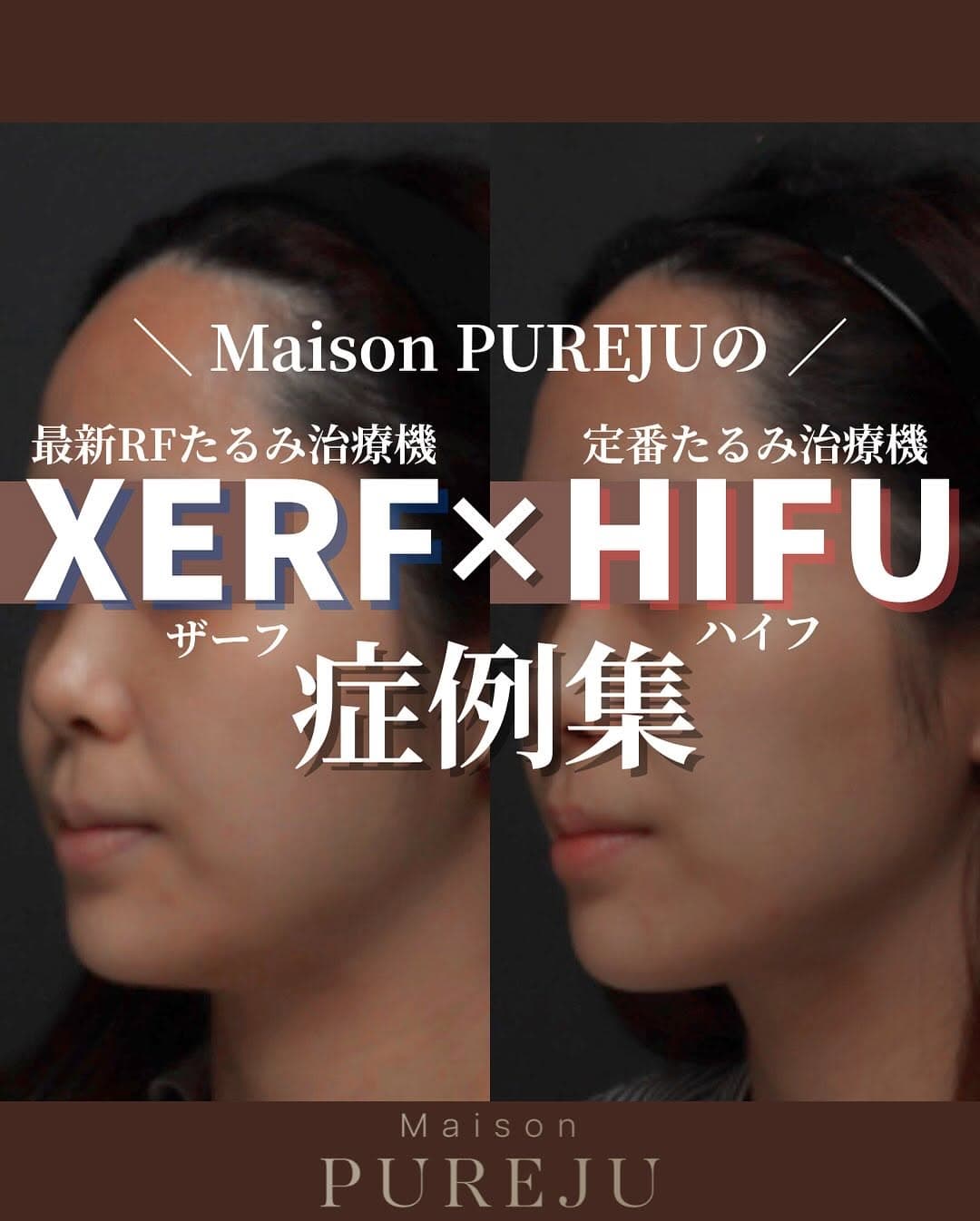 XERF(ザーフ)×HIFU(ハイフ)|2種の周波数と超音波を組み合わせた全層たるみ治療の仕組みと症例