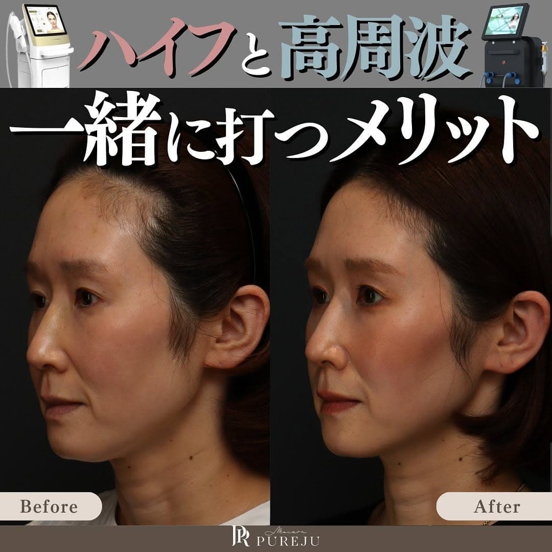 ハイフ×高周波(サーマZI)を組み合わせるメリット|全層に熱を加える立体たるみ治療