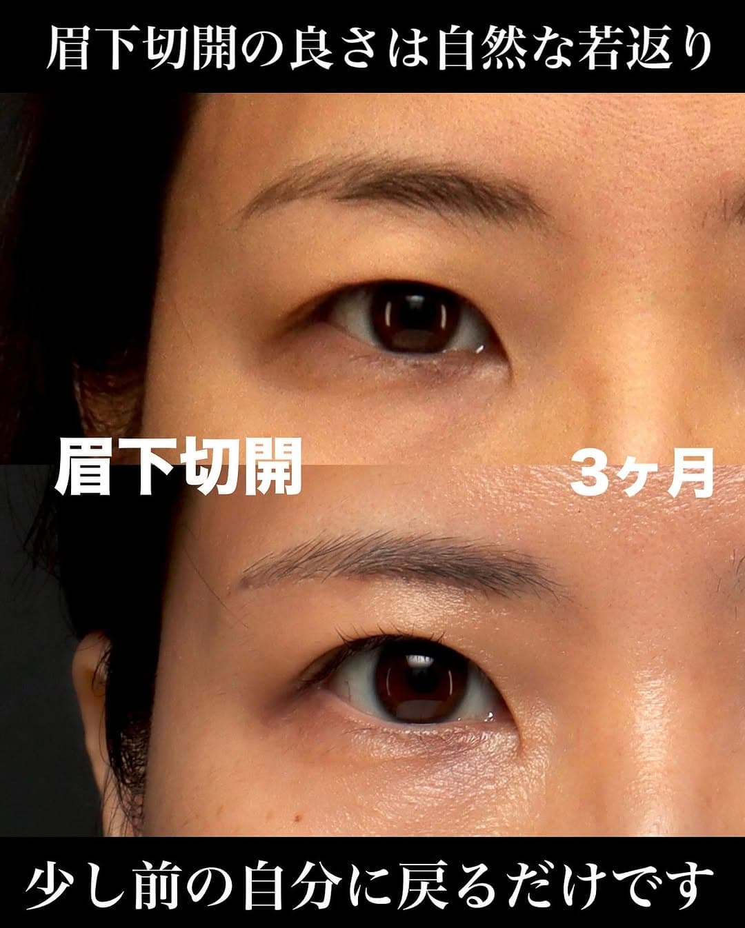 眉下切開でまぶたのたるみを自然に改善し少し昔の自分に戻った症例