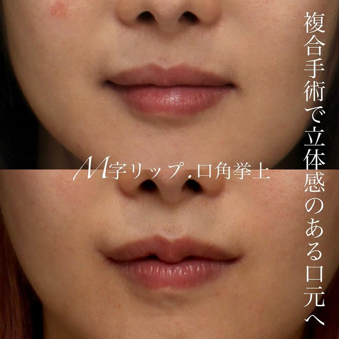 口角挙上+M字リップの複合手術でより女性らしい立体的な唇に整えた症例