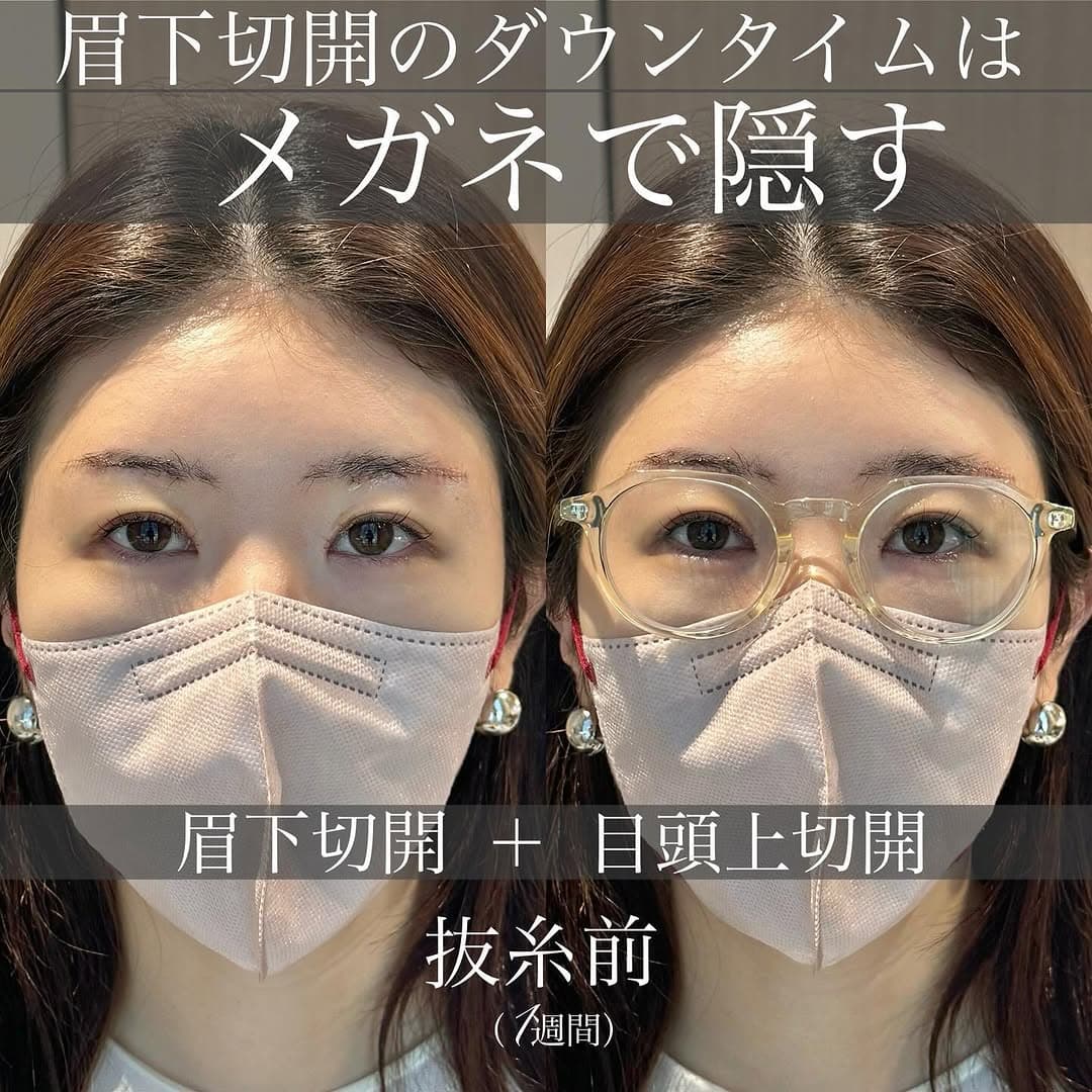 眉下切開のダウンタイム中にメガネで傷跡を目立たなくする方法を紹介した症例