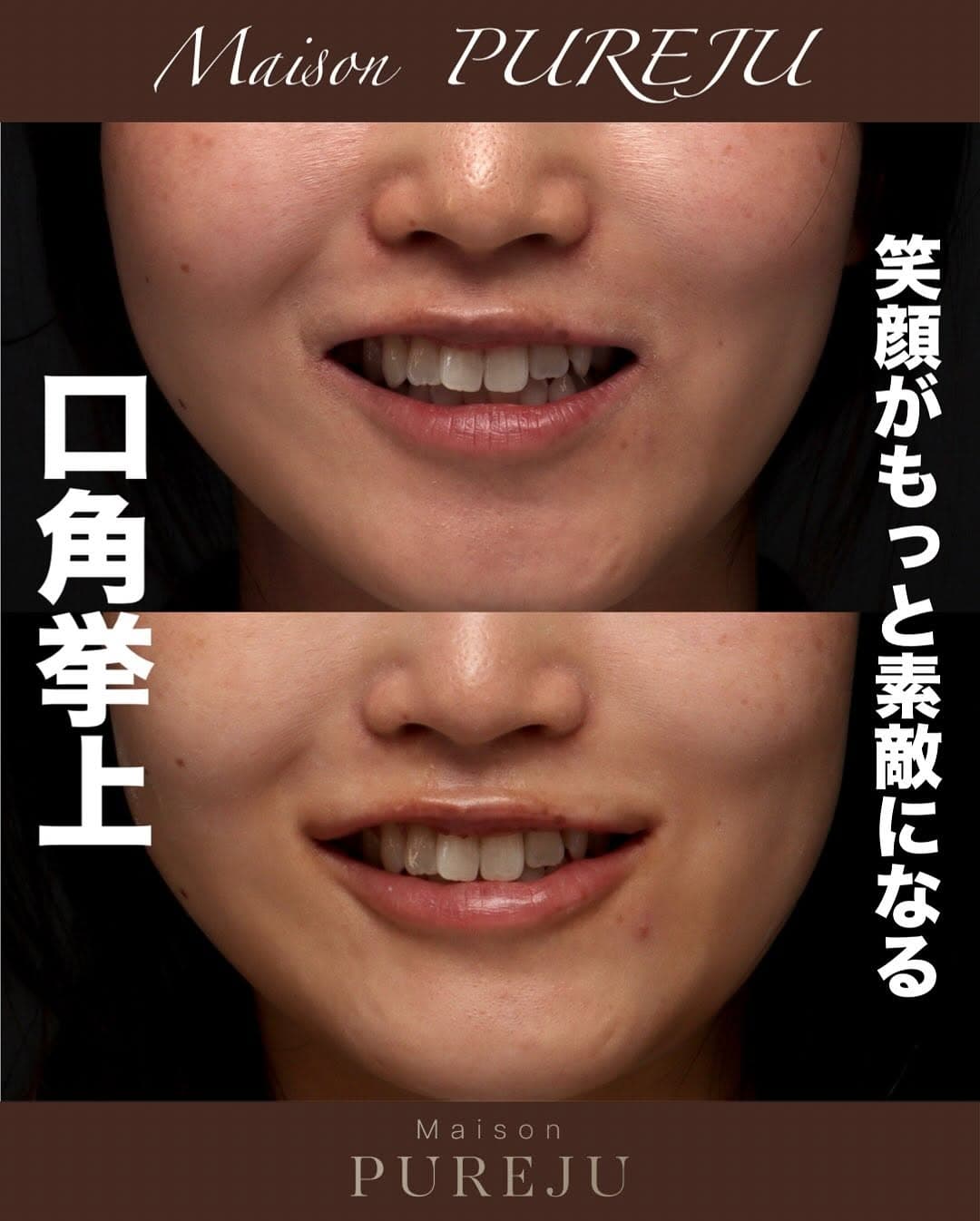 口角挙上+ヒアルロン酸で笑顔が良くなり唇のバランスも整えた症例