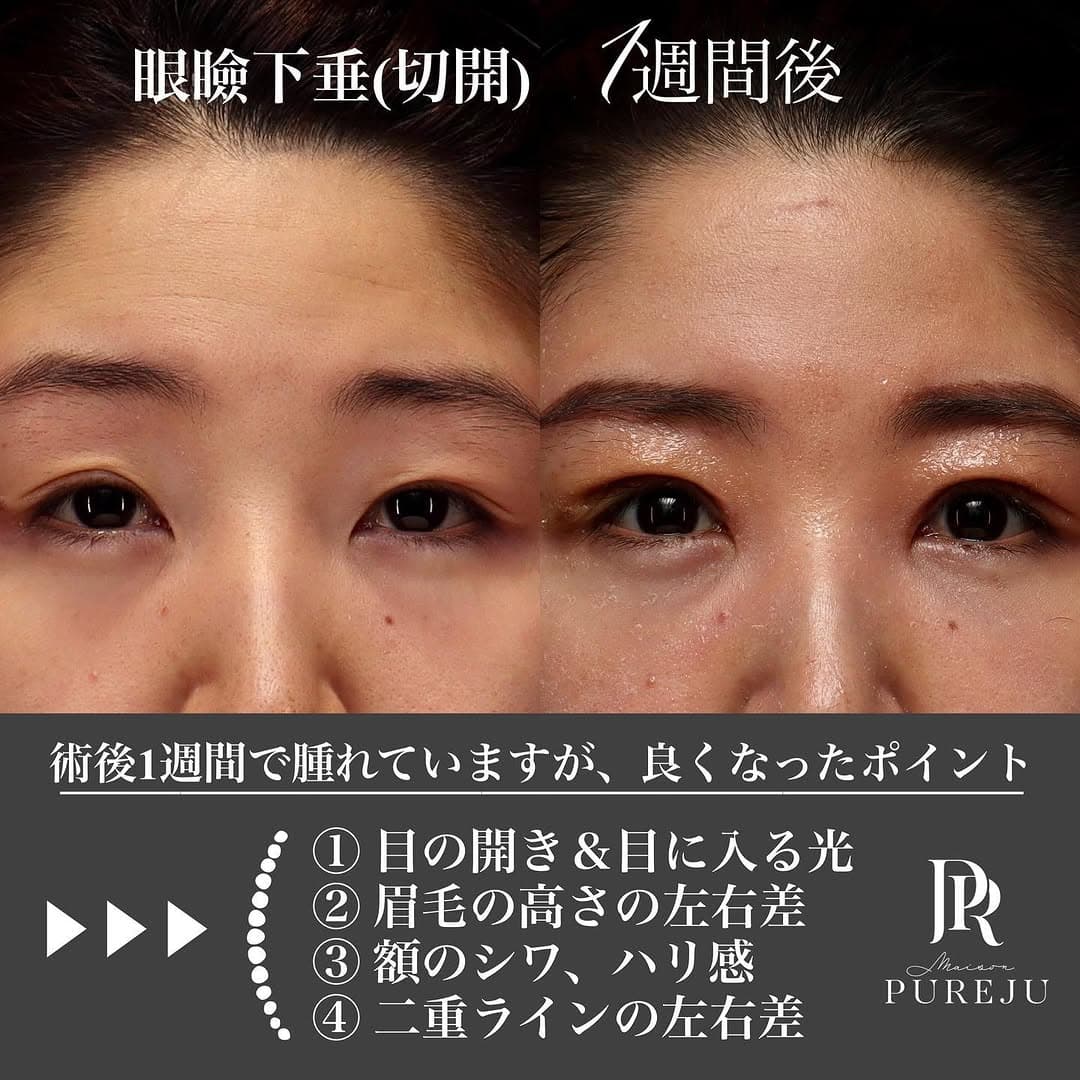 眼瞼下垂手術(切開法)で目の開きと眉の左右差を改善した症例(術後1週間)