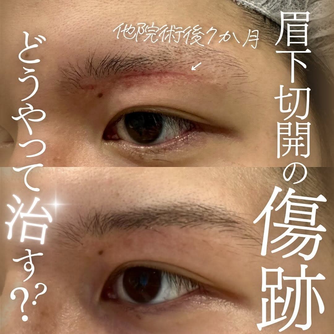 他院眉下切開後の赤みと凹みが残る傷跡をポテンツァで改善した修正症例