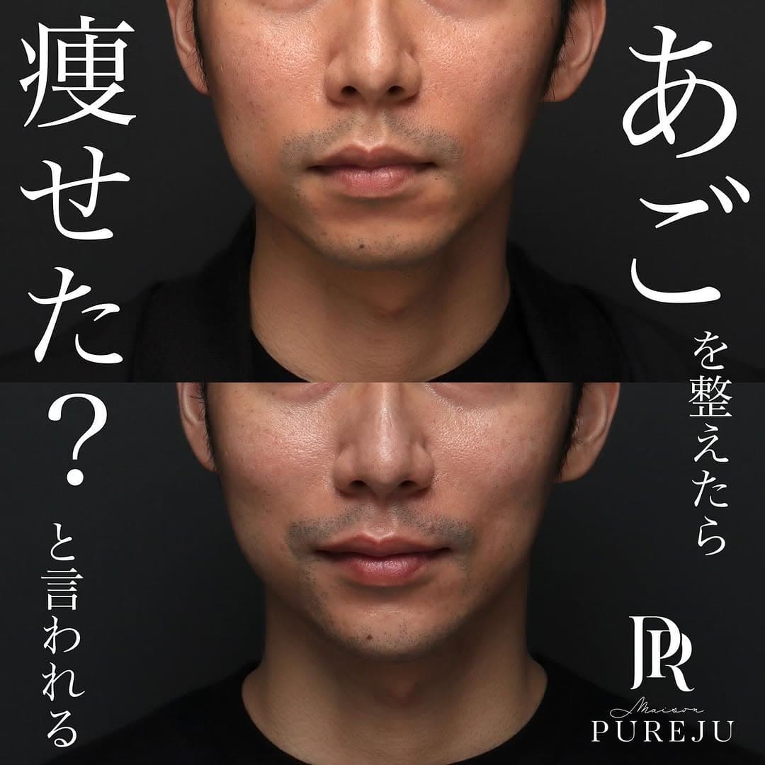 あごのヒアルロン酸注射で輪郭のバランスを整え小顔効果が期待できた症例