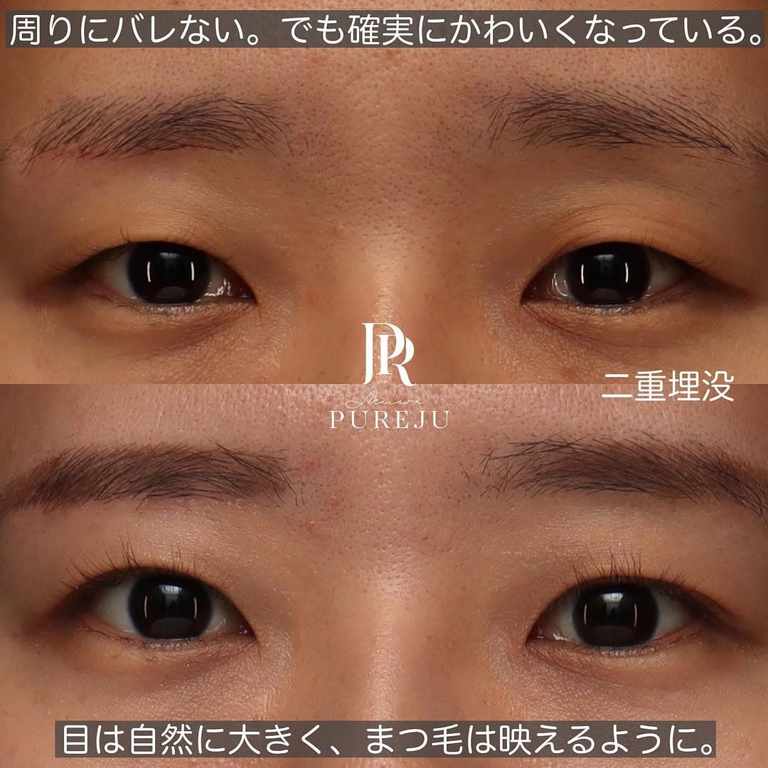 骨格に合わせた自然な末広二重で周りにバレない変化を実現した症例