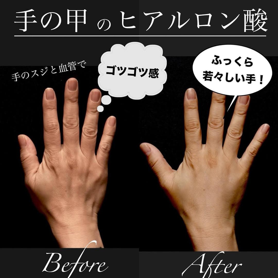 手の甲へのヒアルロン酸注射でふっくら若々しい手元に整えた症例