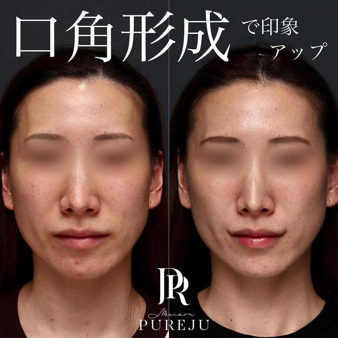口角形成で真顔でも笑顔でも印象が上がった症例