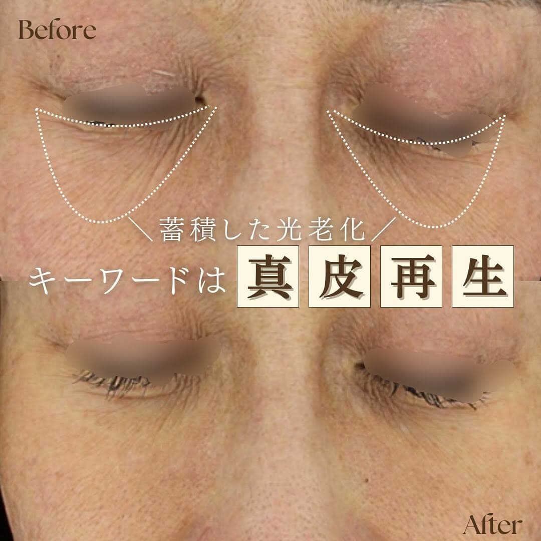 シルキー注射(スキンブースター)で光老化による真皮ダメージを根本から改善した症例
