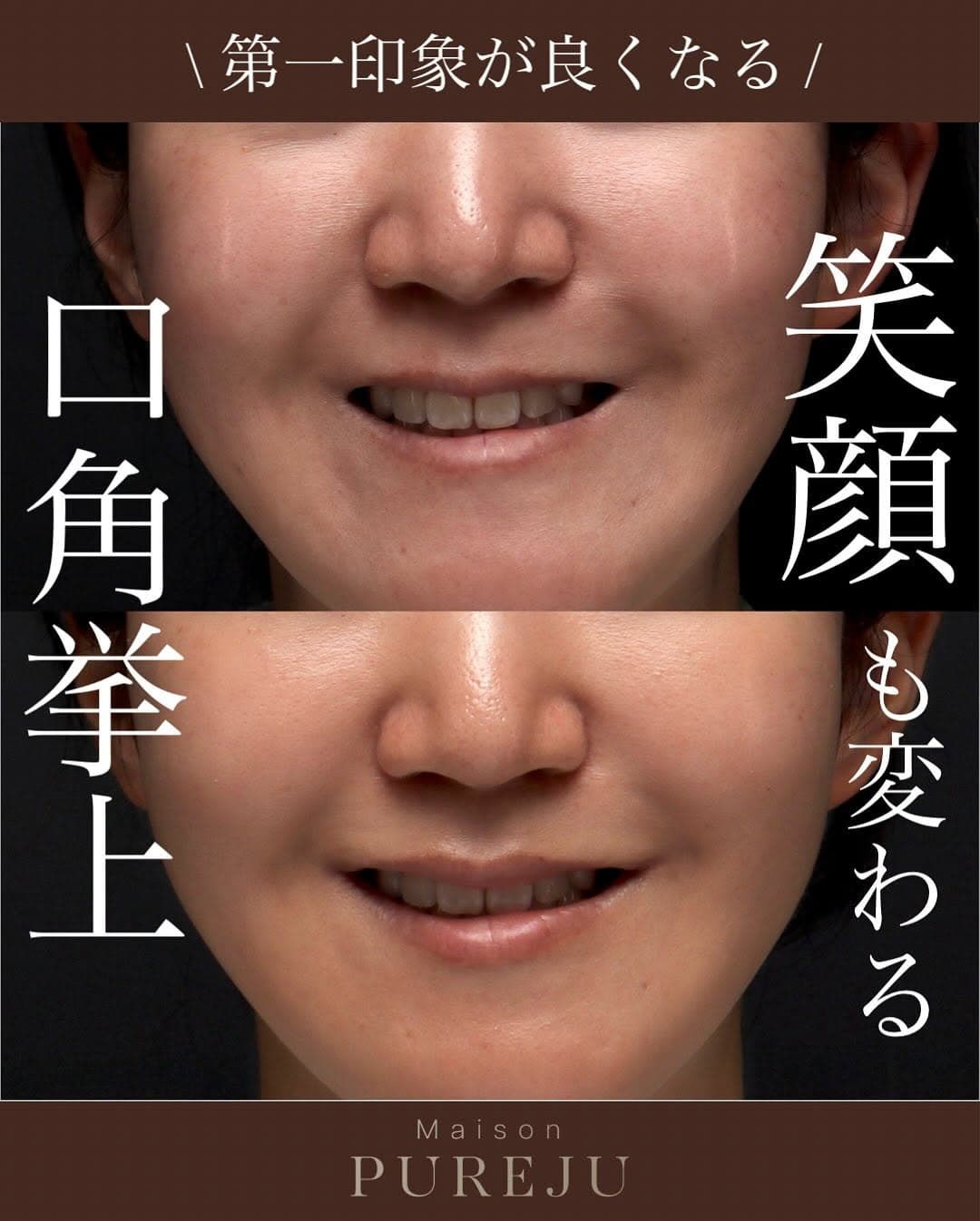 口角挙上で口角のつっぱりを解除し笑顔が変わった症例