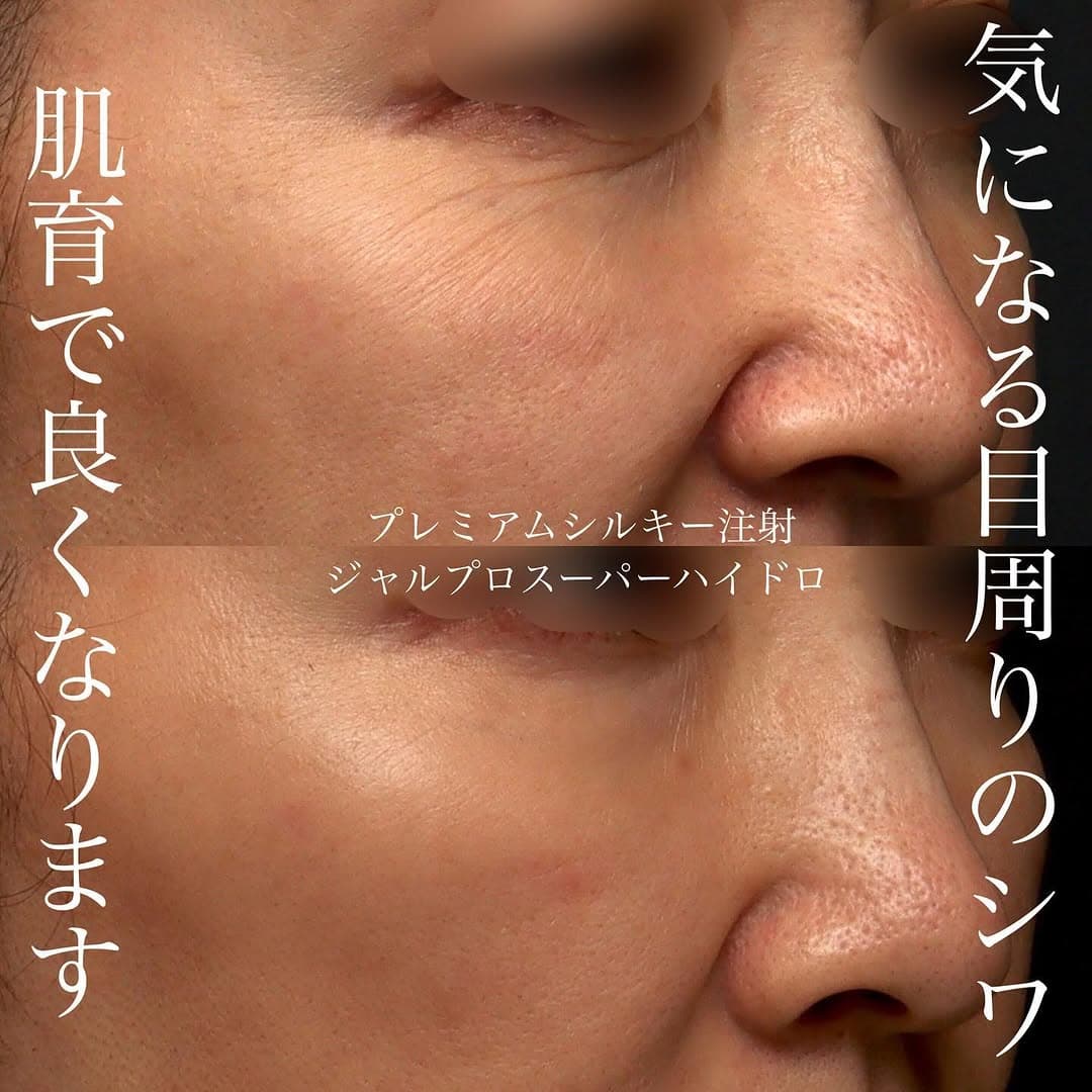シルキー注射+ジャルプロスーパーハイドロの肌育で目周りの小じわと乾燥を改善した症例