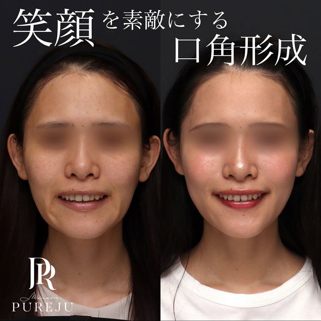 口角形成で笑顔がきれいになりぎこちなさが改善した症例