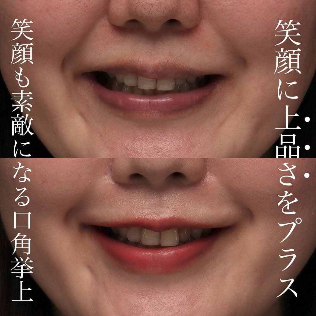口角挙上で笑いにくさを改善しより魅力的な笑顔になった症例