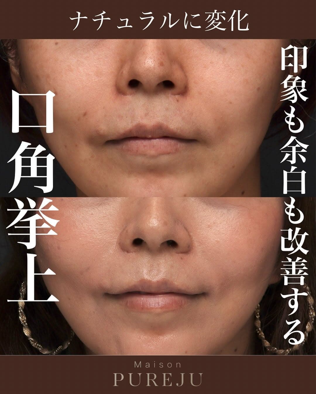 口角挙上+ショートスレッドで印象アップと輪郭の引き締めを同時に実現した症例