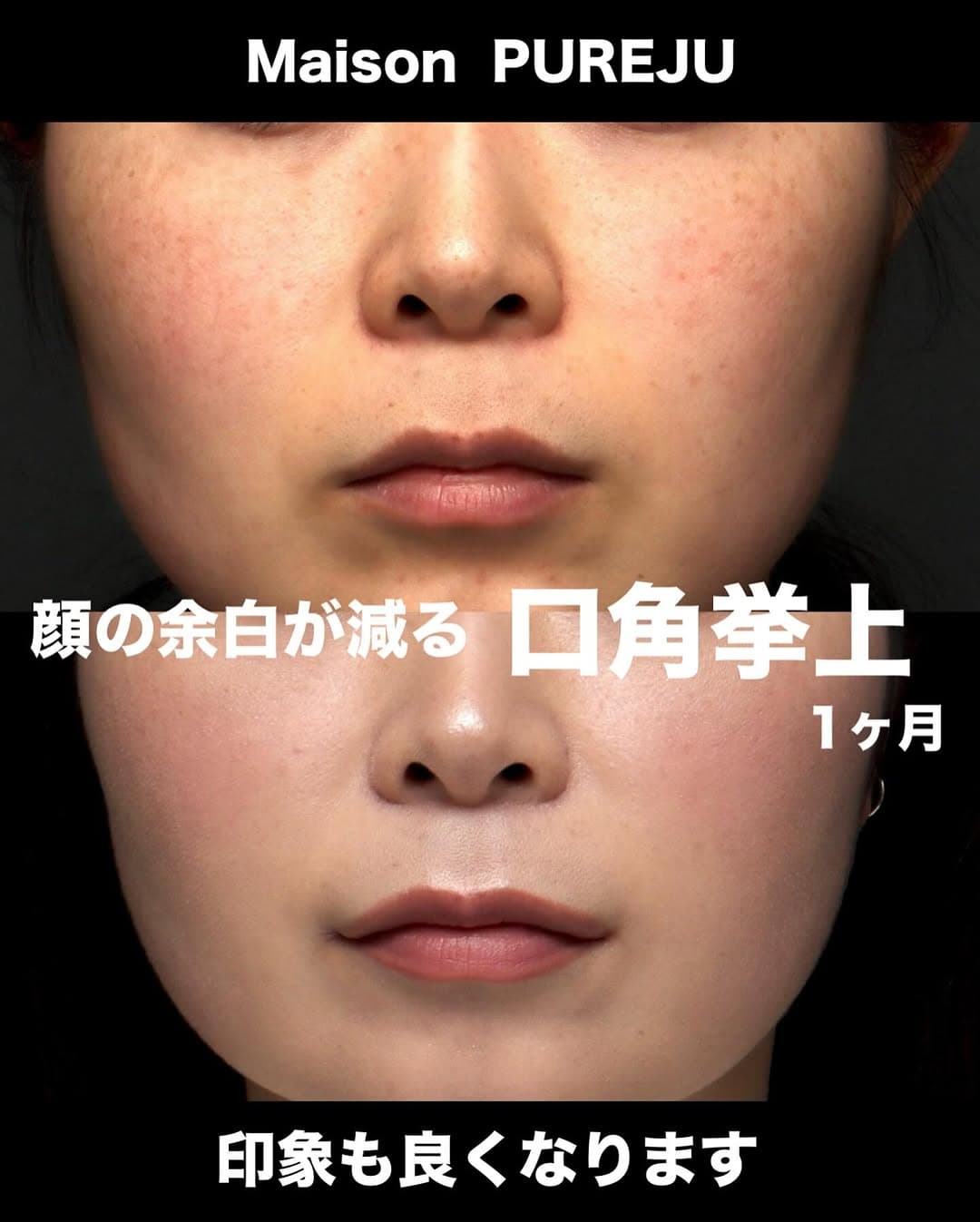口角挙上で印象アップと中顔面短縮による小顔効果を実現した症例