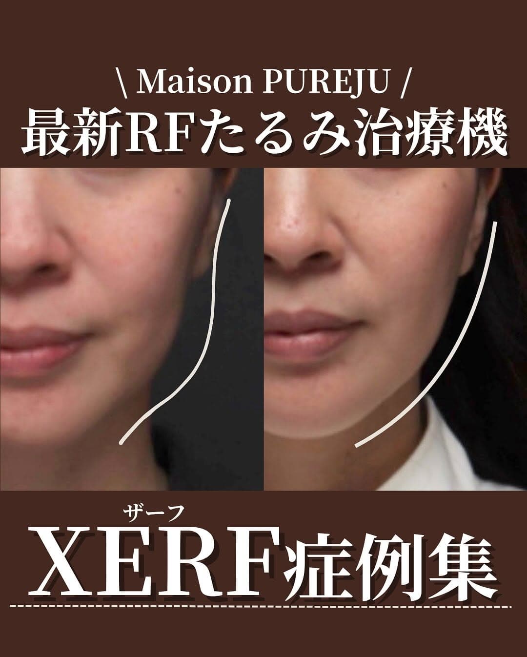 XERF(ザーフ)症例集|痛みが少ない最新RFたるみ治療の効果と術後の変化