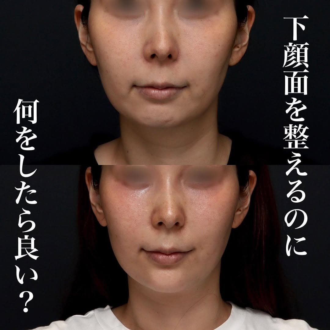 ボトックス×ヒアルロン酸×サーマジェンのコンビネーション治療で下顔面を整えた症例