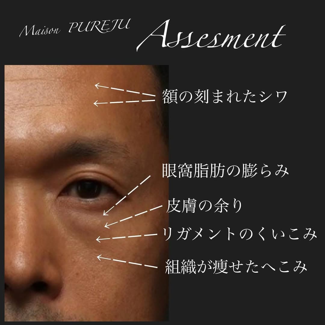 表ハムラ+ヒアルロン酸注射+シルキー注射で男性の自然な若返りを実現した症例(半年以上後)