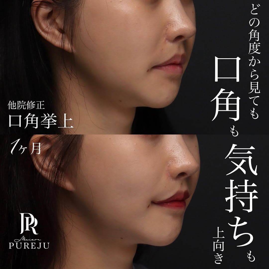 他院修正の口角挙上でしっかりと口角を上げ印象を改善した症例(術後1ヶ月)