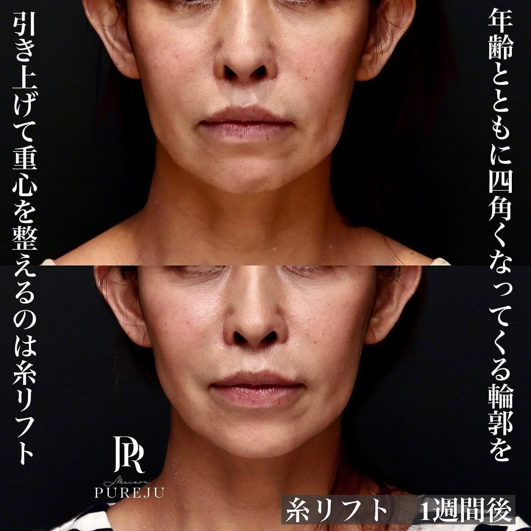 糸リフトとあごボトックスで四角くなった輪郭を整えた症例(術後1週間)