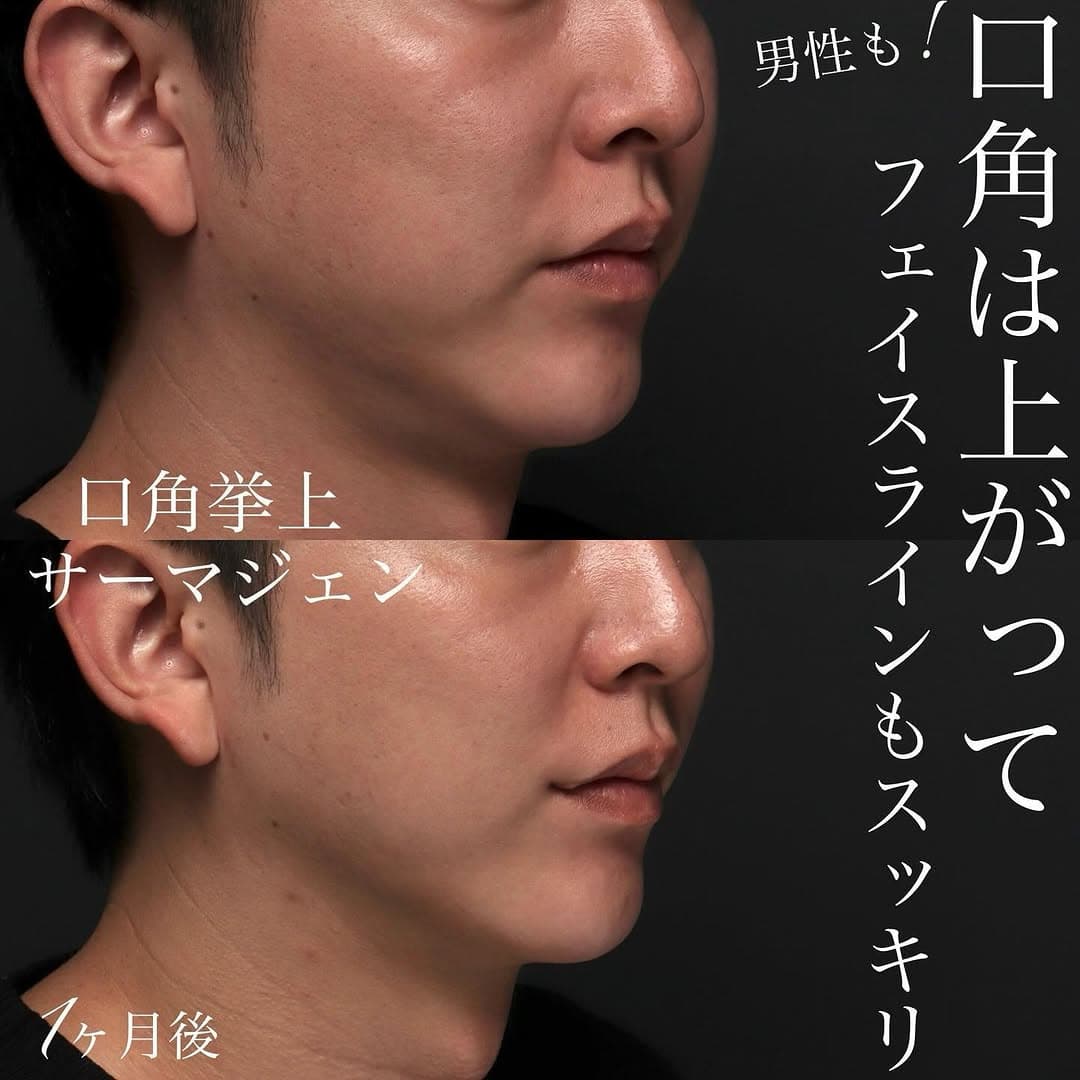 男性の口角挙上+サーマジェンでフェイスラインのもたつきも整えた症例(術後1ヶ月)