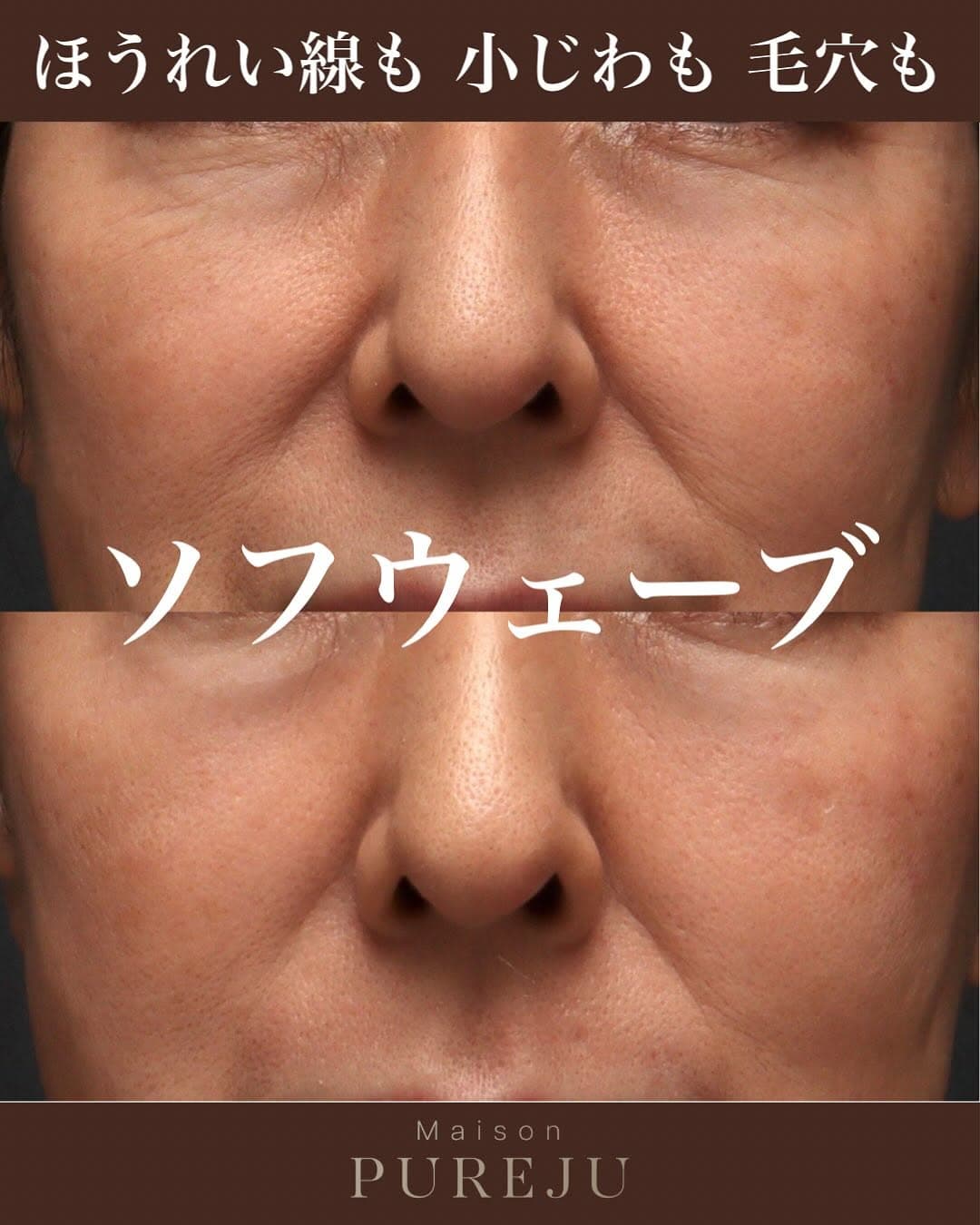 ソフウェーブでほうれい線・小じわ・毛穴をまとめて改善した症例
