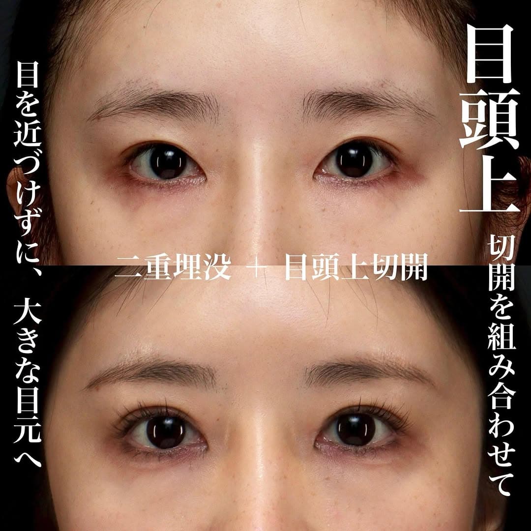 目頭上切開+二重埋没で目と目の距離を保ちながら目元を大きく見せた症例