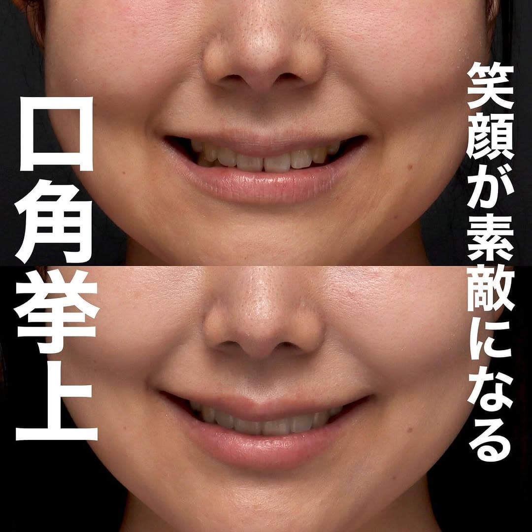口角挙上で笑顔としゃべりやすさも改善した術後3ヶ月の長期経過症例