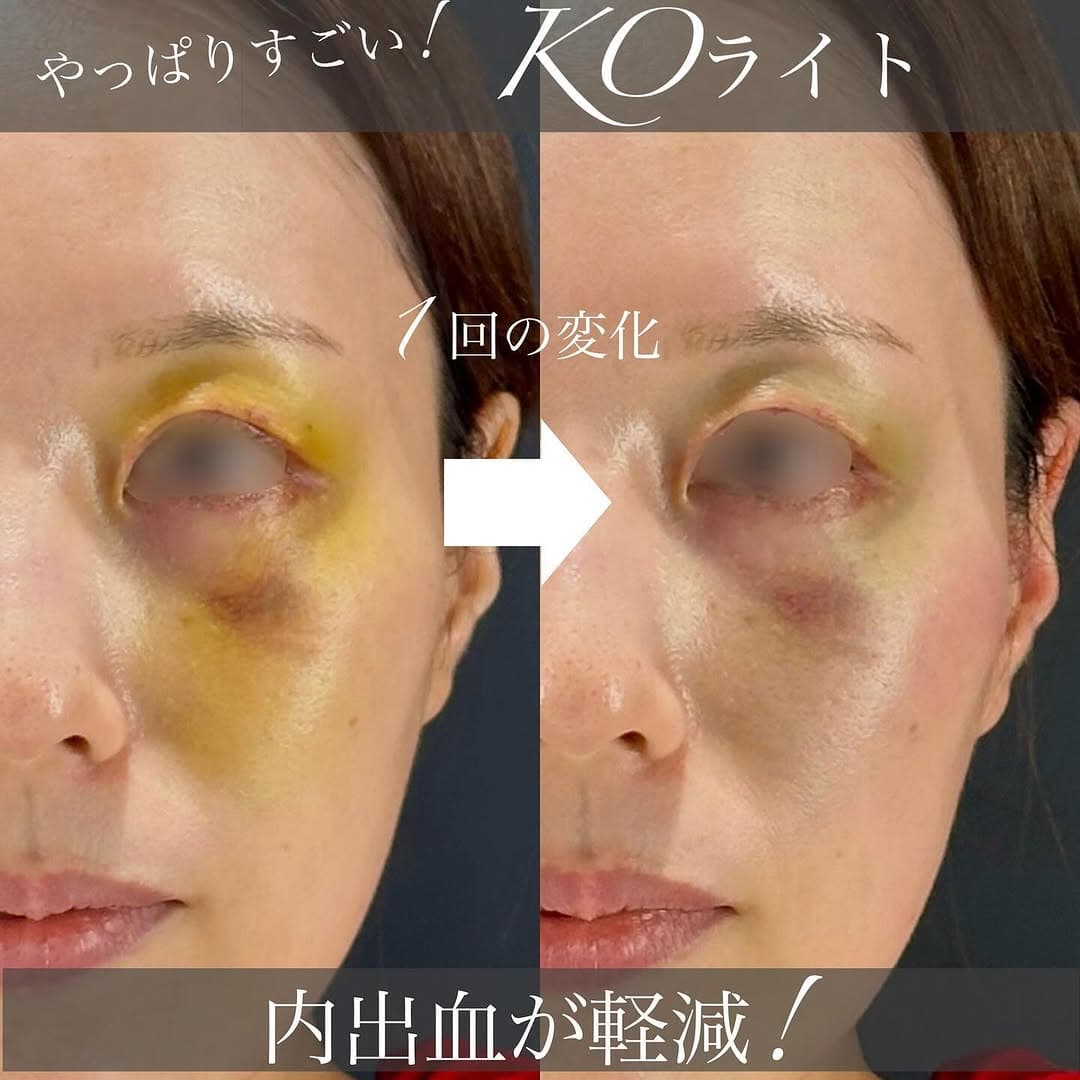 KOライトで年末手術後の腫れと内出血を改善し仕事始めに備えたダウンタイム対策症例