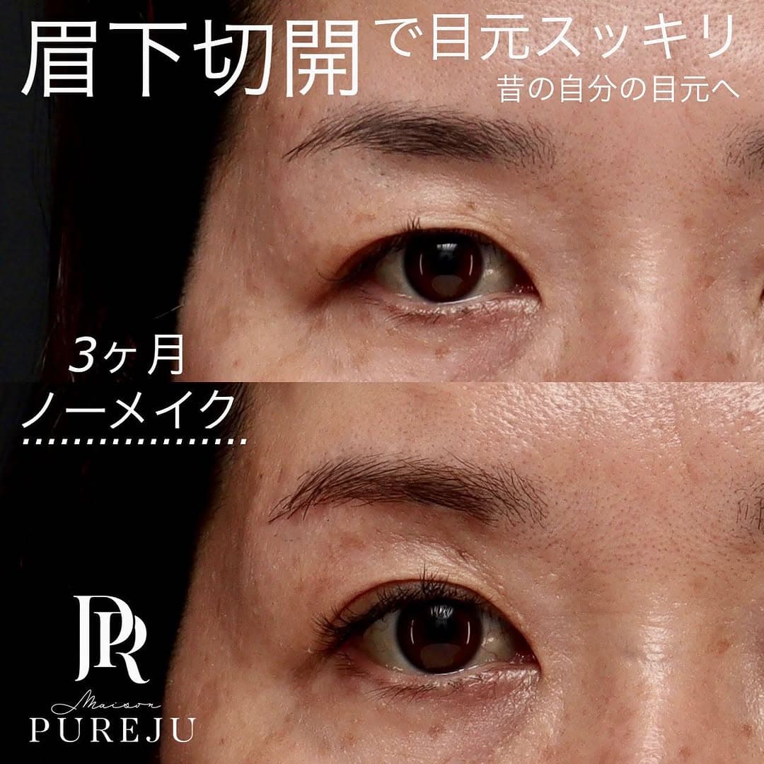 眉下切開で埋もれた二重とまつ毛を復活させ昔の目元に戻した症例(術後3ヶ月)