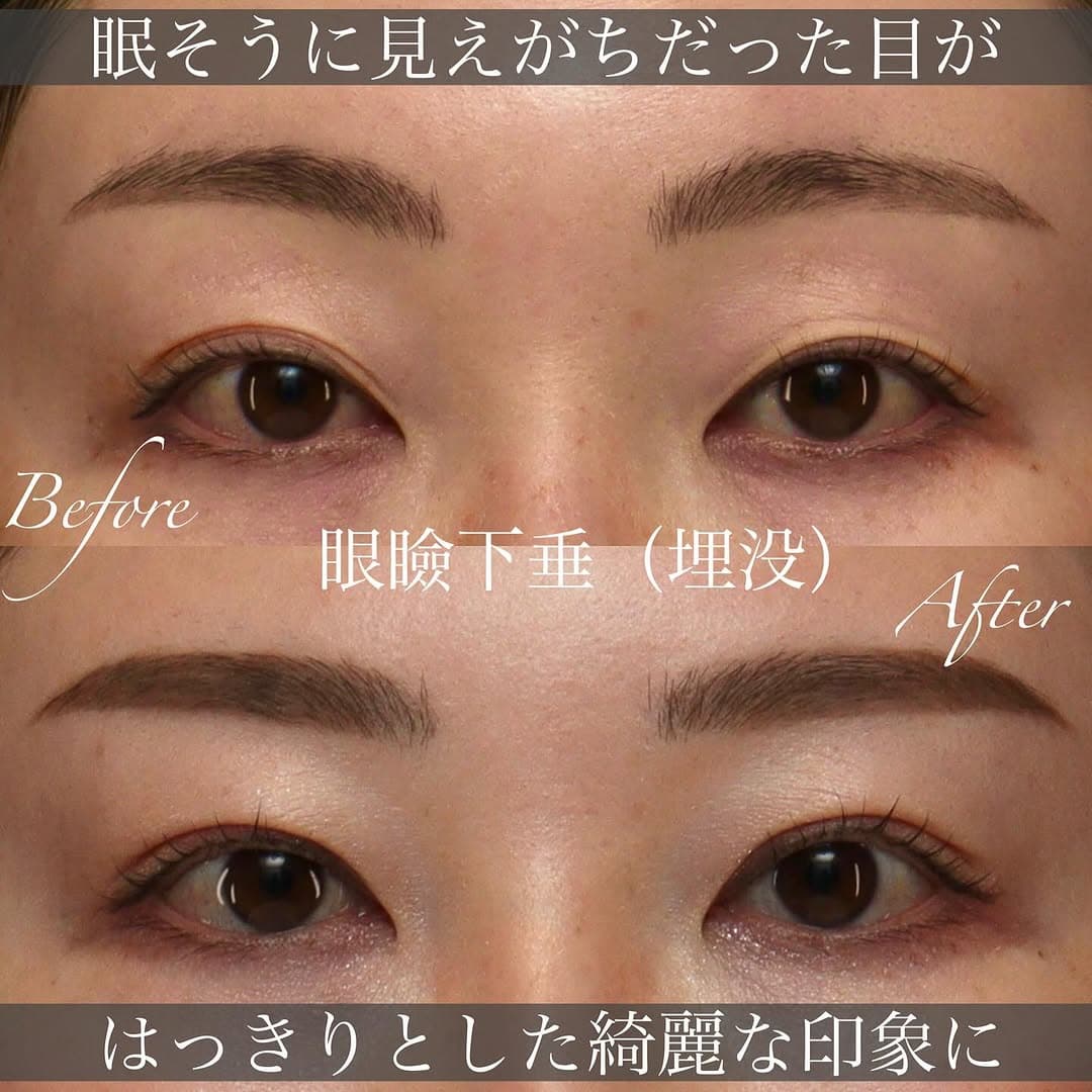 眼瞼下垂の切開法・埋没法の違いと手術の変化を解説した症例