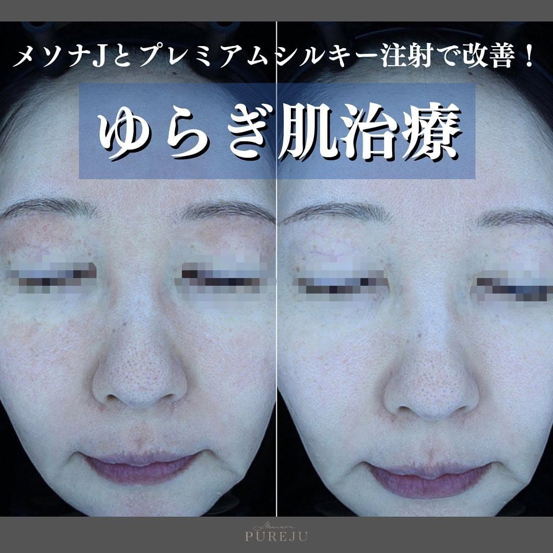 ゆらぎ肌の原因と治療|赤みの種類(乾燥・炎症・真皮の衰え・血管拡張)で選ぶアプローチ