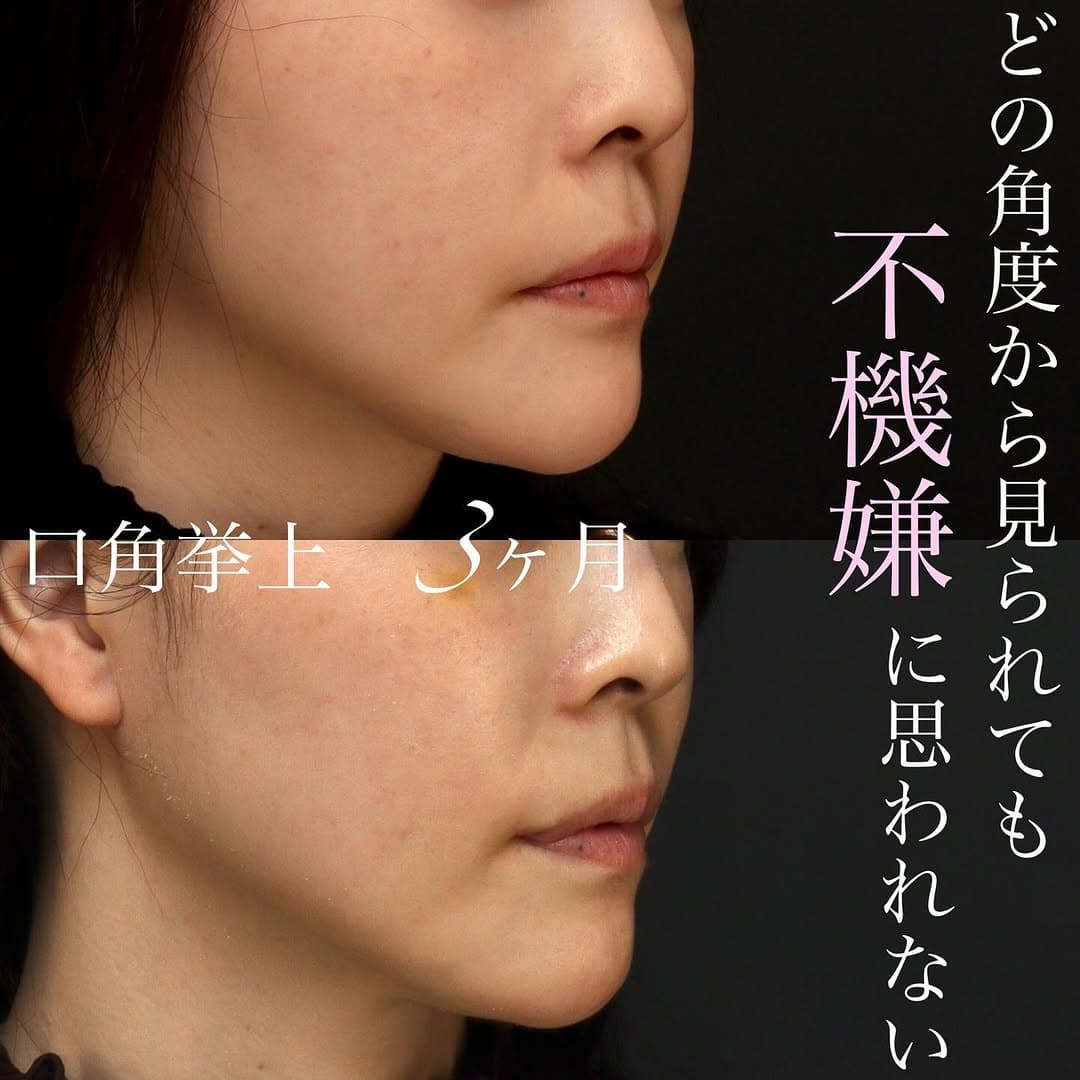 口角挙上でふとした瞬間・斜めから見ても口角が上がっている印象の良い口元に整えた症例
