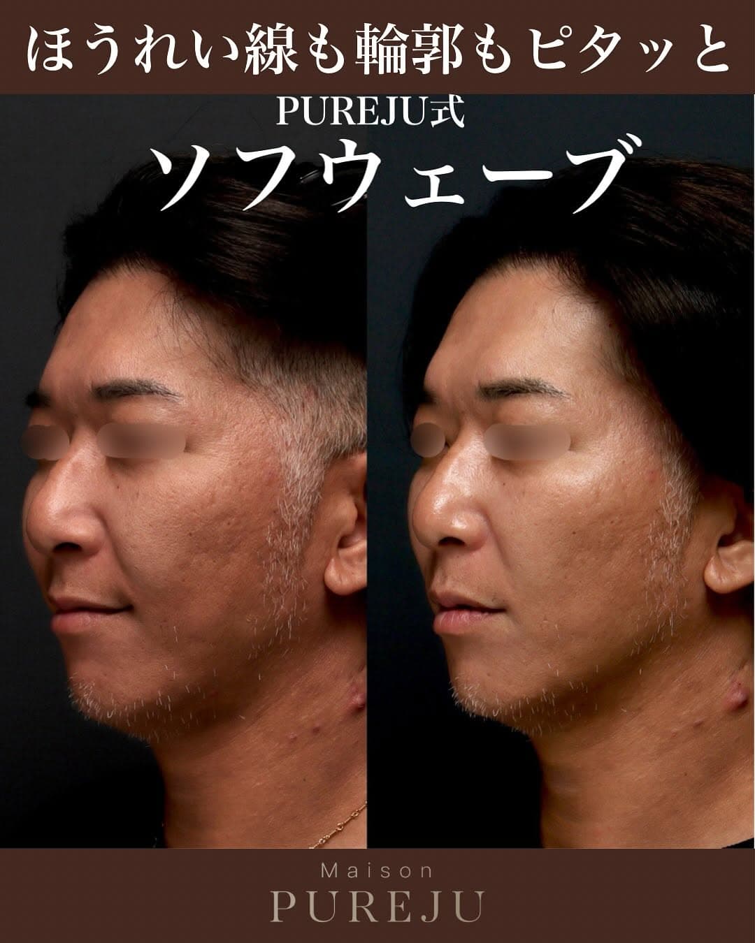 ソフウェーブであご下フェイスラインの皮膚のたるみをピタッと引き締めた症例