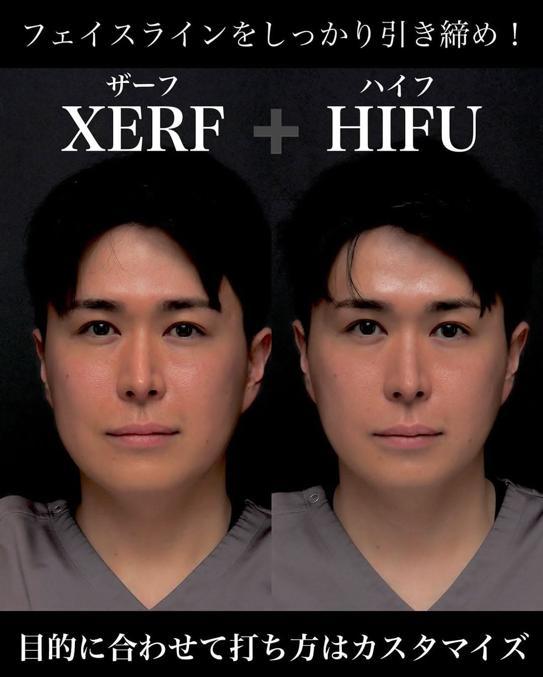 ウルトラセルZi(HIFU)+ザーフ(RF)の組み合わせでたるみを全層引き締めた症例