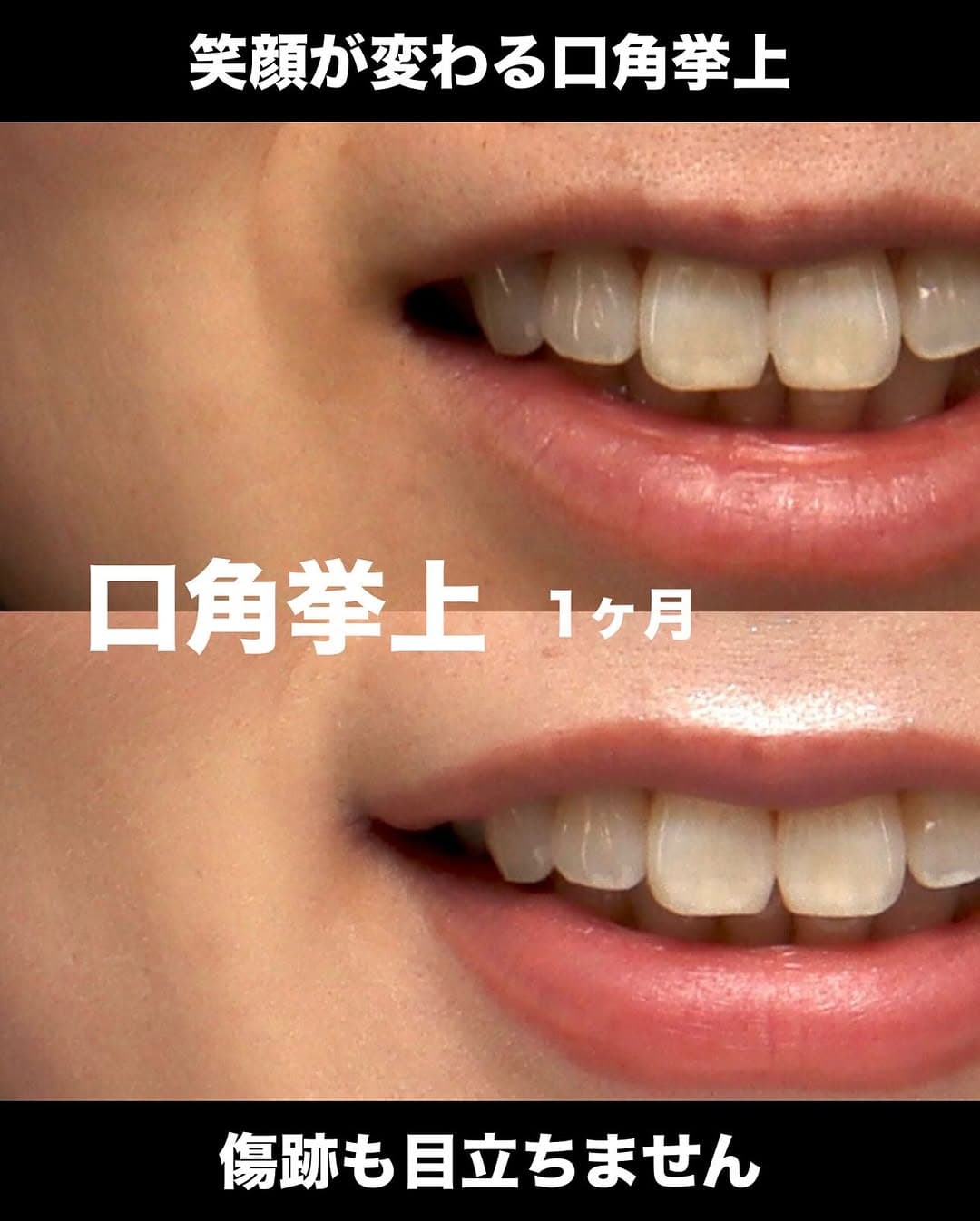 口角挙上でつっぱりが解除され笑顔がかわいくなった症例